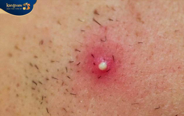 Mụn mủ hình thành trên da