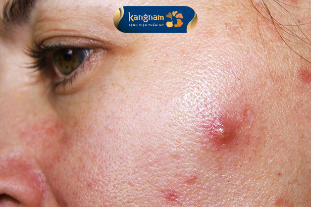 Mụn nang nổi rõ trên bề mặt với da màu đỏ bao quanh 