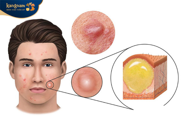 Mụn hình thành do vi khuẩn hoạt động tại lỗ chân lông bị bít tắc 