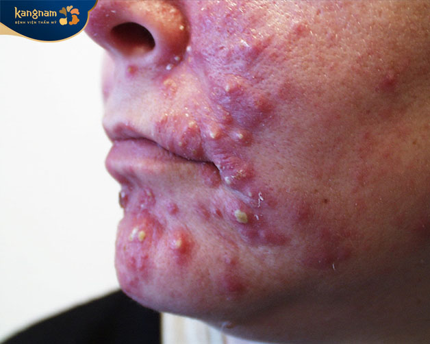 Nếu không điều trị kịp thời sẽ khiến mụn lây lan rộng và nhiễm trùng da 