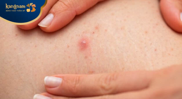 Những ai có nguy cơ thường xuyên bị mụn viêm nang lông?