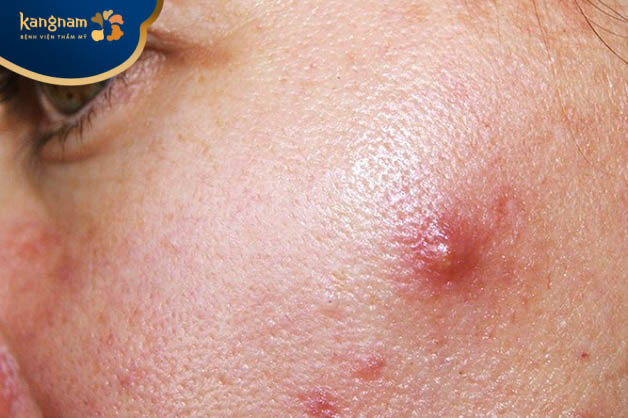 Mụn viêm nang có thể xuất hiện trên mặt