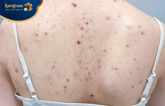 Viêm nang lông có thể xuất hiện dưới dạng mụn đỏ