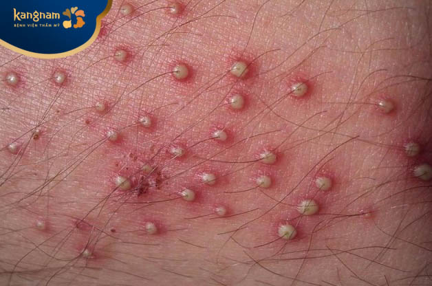 Mụn nang lông là bệnh lý về da đa phần do các nang lông bị nhiễm trùng