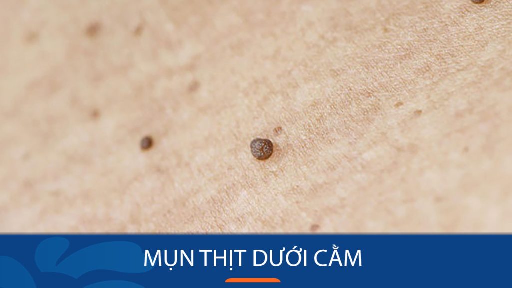 Mụn thịt dưới cằm: Nguyên nhân, cách điều trị và phòng ngừa