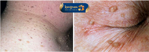 Nguyên nhân mụn thịt lây lan khắp người là do không điều trị đúng lúc