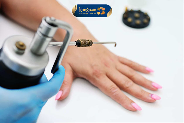 Chấm nitơ là liệu pháp nhiều người lựa chọn để loại bỏ mụn thịt dư