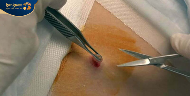 Trước khi cắt bỏ mụn cần phải đảm bảo dụng cụ sạch sẽ và vô khuẩn