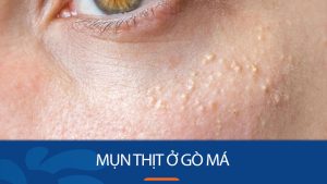 Mụn thịt ở gò má:Bí quyết đánh bay mụn thịt ở gò má chỉ trong 7 ngày