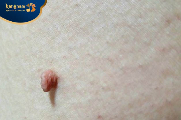 Mụn thịt đỏ trên cơ thể có thể do bạn đang mắc phải bệnh tiểu đường