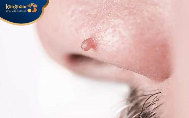 Mụn thịt sưng đỏ do kích ứng với hóa chất