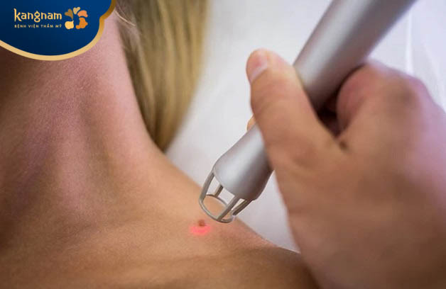 Sử dụng phương pháp laser loại bỏ mụn thịt đỏ