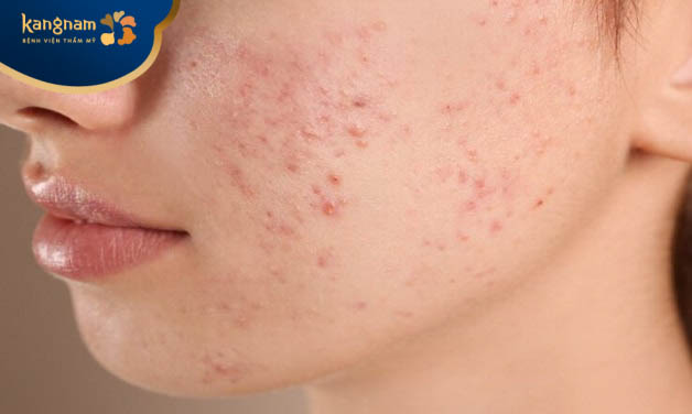 Chăm sóc không đúng cách khiến da dễ nổi mụn