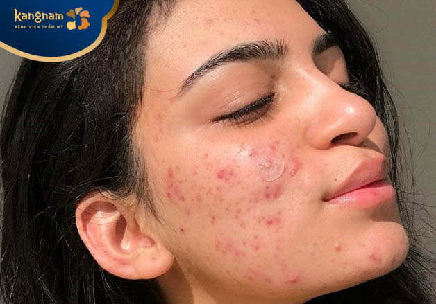 Tuổi dậy thì là lứa tuổi dễ bị mụn nhất