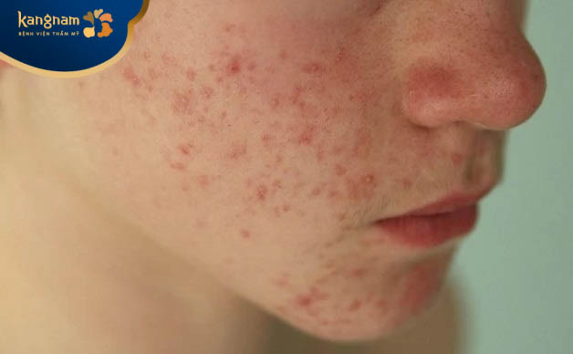 Sự thay đổi nội tiết tố khiến da bị tăng tiết dầu nhờn, dễ nổi mụn hơn