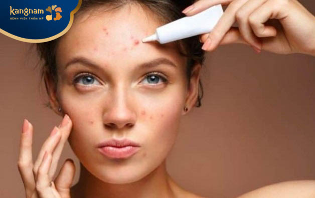 Sử dụng các loại kem bôi thoa điều trị mụn