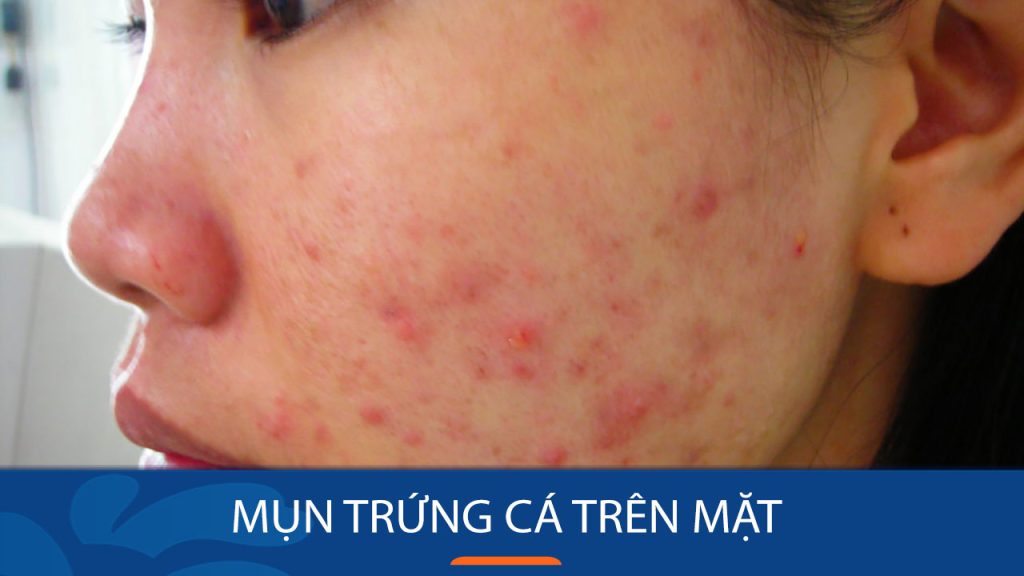 Bí quyết loại bỏ mụn trứng cá tận gốc, lấy lại làn da sáng mịn