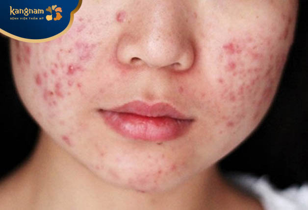 Trứng cá do rối loạn nội tiết tố