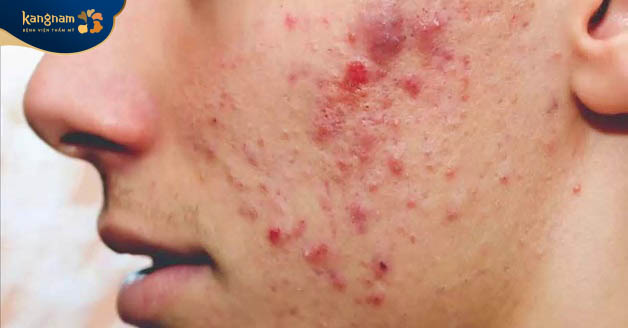 Mụn bị viêm do lỗ chân lông bít tắc và vi khuẩn P. acnes xâm nhập gây nên