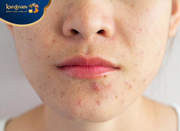 Mụn viêm mọc ở cằm có thể do rối loạn nội tiết tố