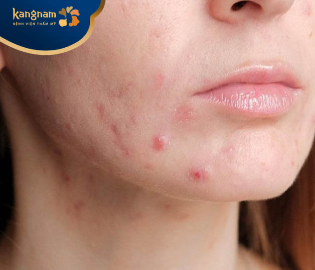 Mụn viêm mọc ở cằm có nguy hiểm không?