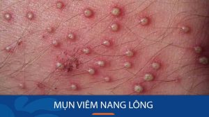 Bí quyết loại bỏ mụn viêm nang lông tận gốc, ngăn ngừa tái phát