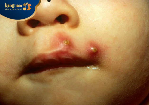 Nặn mụn không đúng cách sẽ làm cho nốt mụn đinh râu sưng đỏ, có thể xuất hiện dịch tiết ra