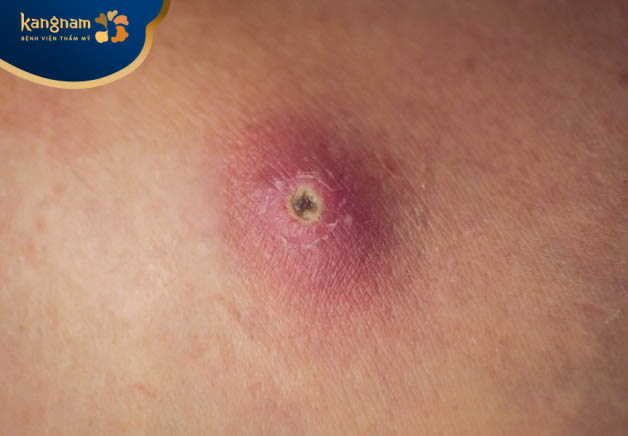 Nặn mụn đinh râu có bị méo mồm hay không?