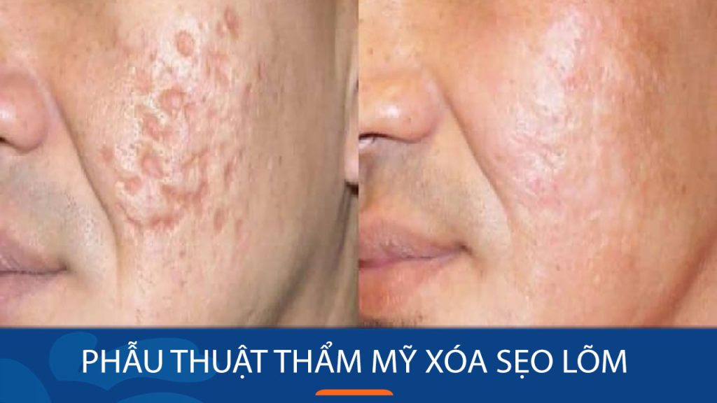 Phẫu thuật thẩm mỹ xóa sẹo lõm: Giải pháp hoàn hảo cho làn da mịn màng!