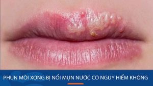 Phun môi xong bị nổi mụn nước có nguy hiểm không?Những lưu ý