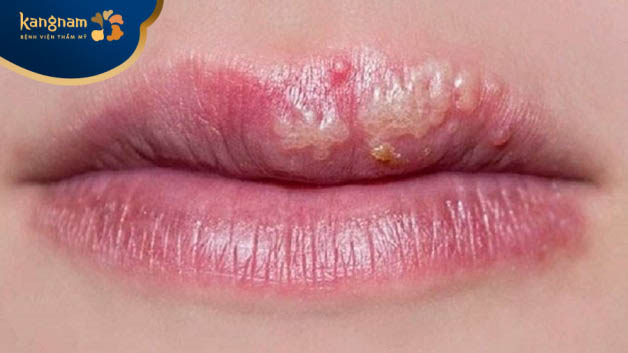 Sau phun môi, nếu bị nổi mụn nước thì đây có thể là dấu hiệu bất thường cho thấy môi bị nhiễm khuẩn