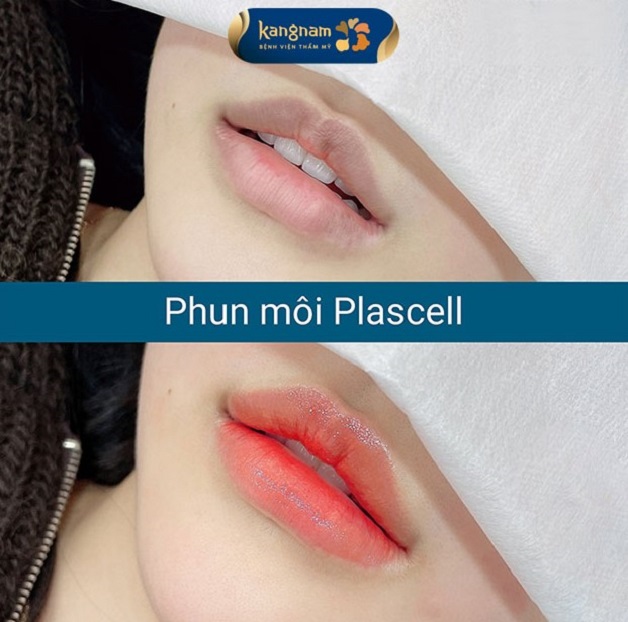 Môi trước và sau phun xăm ứng dụng công nghệ Plascell