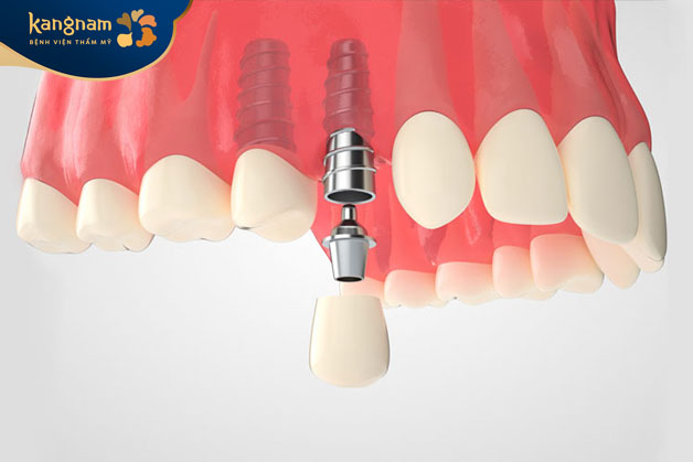 Quy trình cấy ghép Implant chuẩn y khoa
