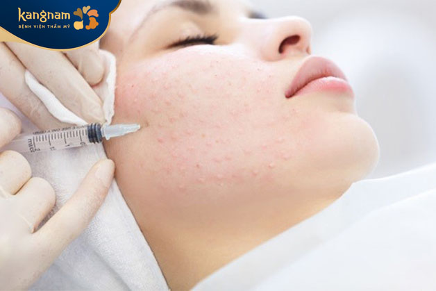 Quy trình tiêm meso diễn ra nhanh gọn, an toàn