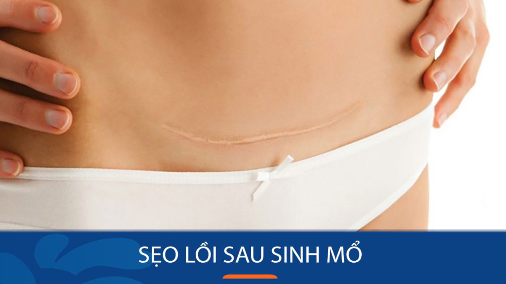 Sẹo lồi sau sinh mổ – Giải mã nguyên nhân và 7 bí quyết làm mờ hiệu quả