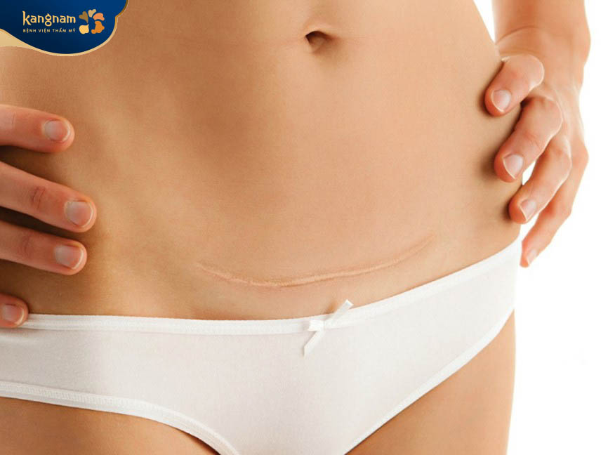 Sẹo lồi sau đẻ mổ do cơ địa, chế độ chăm sóc, nhiễm trùng