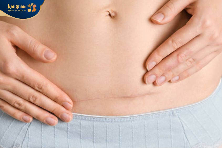 Sản phụ cần chú ý chăm sau vết thương