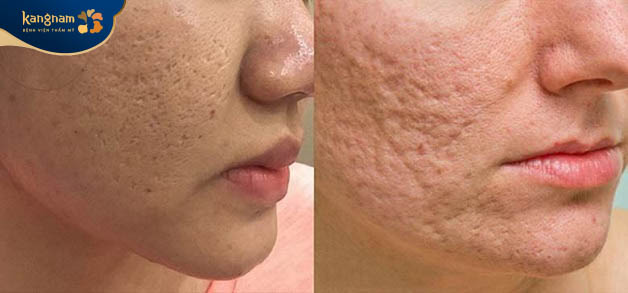 Những vết lõm hình thành trên da