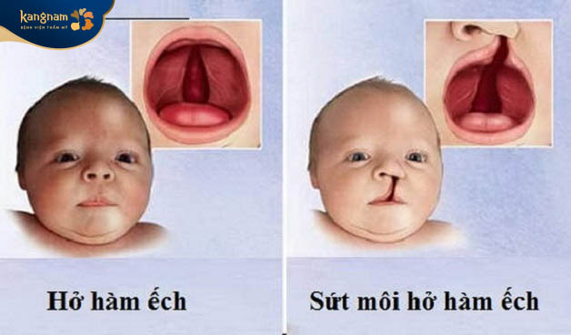 Dị tật hở hàm ếch và sứt môi