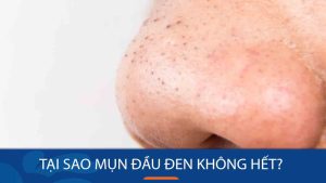 Tại sao mụn đầu đen không hết? “mọc như nấm”? Giải pháp cho làn da sáng khỏe