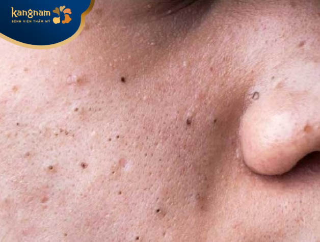 Mụn đầu đen không hết được là bởi sau nặn mụn, không có biện pháp để chăm sóc da phù hợp