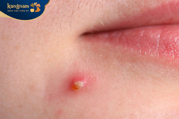 sự bít tắc của lỗ chân lông