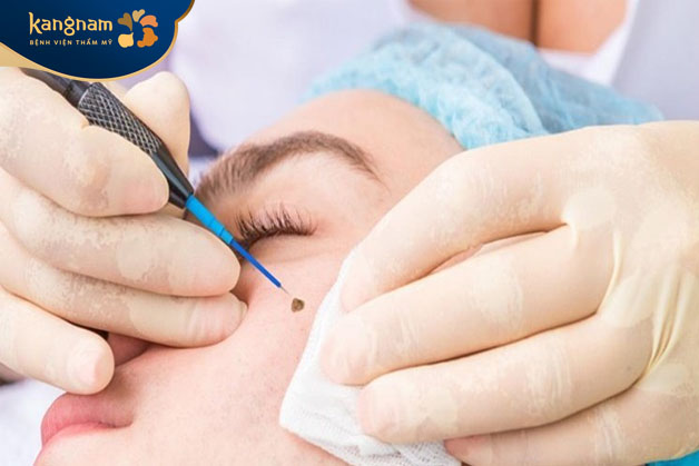 tẩy nốt ruồi nếu không thực hiện cẩn thận có thể dẫn đến những hậu quả như sẹo lõm hoặc sẹo thâm