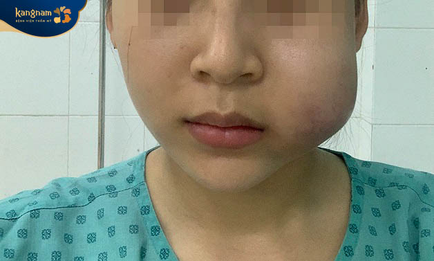 Sau tiêm filler vết thương bị sưng