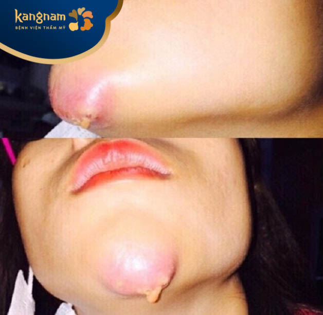 Biến chứng filler không tan sau tiêm