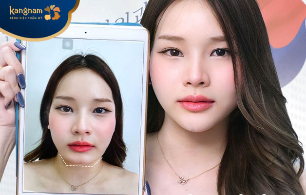 Trung bình, tiêm filler cằm sau khoảng 6 tháng đến 2 năm sẽ tan