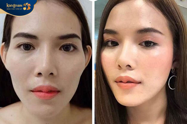 Tiêm filler thái dương có mức chi phí cao hay thấp tùy thuộc vào địa chỉ thẩm mỹ