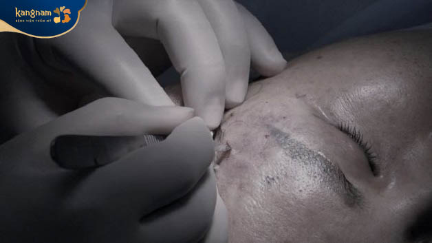 Biến chứng có thể gặp khi tiêm filler thái dương giá rẻ