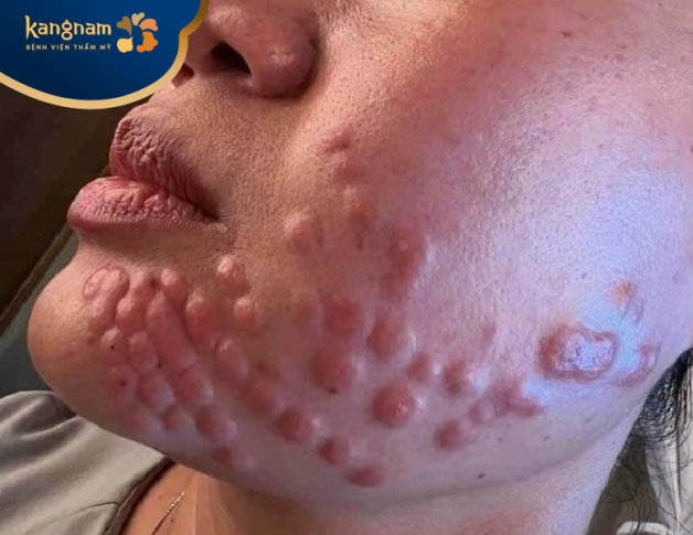 Phù nề do tiêm meso kém chất lượng