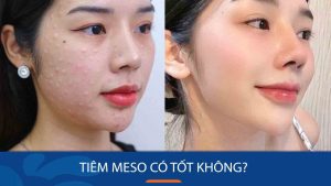 Tiêm meso có tốt không? Cần lưu ý điều gì